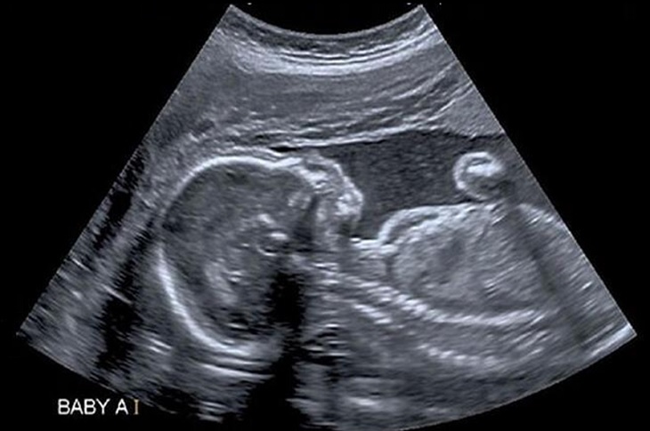 Haberi temsilen, ana rahmindeki bir bebek görüntüsü objektife yansıyor.