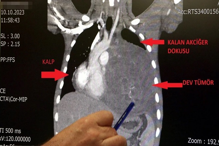 Hastadaki dev tümörün film görüntüsü objektife yansıyor.