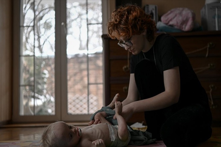 Bakımı yapılan bir zayıf bebek resmi objektife yansıyor.