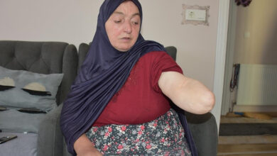 Huriye Kaya, kolunun ampute edilen ön bölümünü gösteriyor.