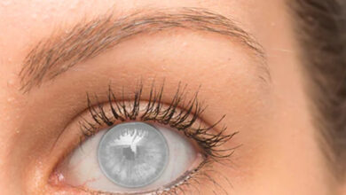 Bir kadının sol gözüne lens olarak yerleştirilmiş implant.