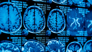 Görselde beyin tomografi sonucu ve beynin her açıdan görüntüsü var.