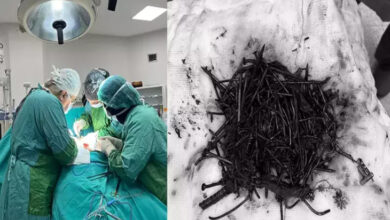 Fotoğrafta iki farklı görsel yer alıyor. Sol taraftaki görselde ameliyathanede bir hasta yatırılmış ve ameliyat ediliyor. Doktorlar başında duruyor. Sağ taraftaki fotoğrafta ise bir bezin üzerinde birçok metal demir ve çivi var.