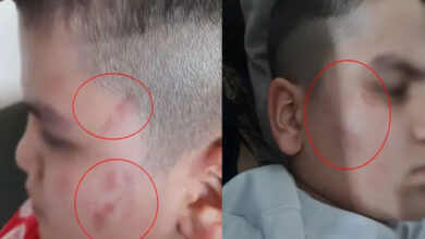 Otizmli öğrencinin yüzündeki morlukların iki fotoğrafı.