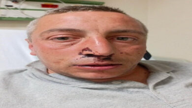 Bu görselde, bir hastane ya da sağlık kuruluşunda olduğu anlaşılan bir ortamda, yaralı bir adam yer almakta. Adamın yüzünde, özellikle burun ve dudak çevresinde morluklar, kan izleri ve darp belirtileri görülüyor. Gözleri hafif şişmiş ve yorgun bir ifade taşıyor. Üzerinde gri bir tişört bulunuyor. Arka planda hastane ekipmanları yer almakta.