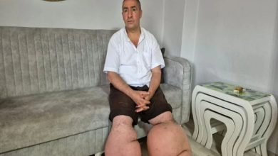 Fil hastalığının sebep olduğu şişkin bacaklarıyla Seyfettin Taşçı koltukta oturuyor.