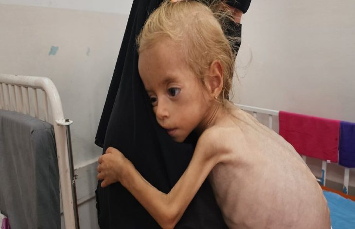 Ciddi derecede yetersiz beslenmiş bir çocuk son derece zayıf, cildi kemiklerine yapışmış durumda ve vücut gelişimi oldukça geri kalmış görünmektedir. Saçları ince ve seyrek, yanakları çökmüş, gözleri büyük ve hüzünlüdür. Çocuk, siyah çarşaf giymiş bir yetişkin kadına sıkı sıkıya sarılmıştır.