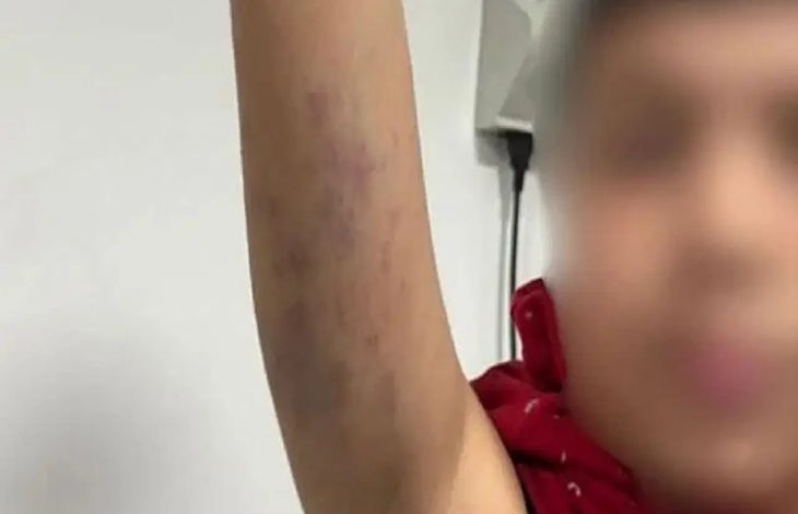 Kolu morarmış otizmli öğrenci.