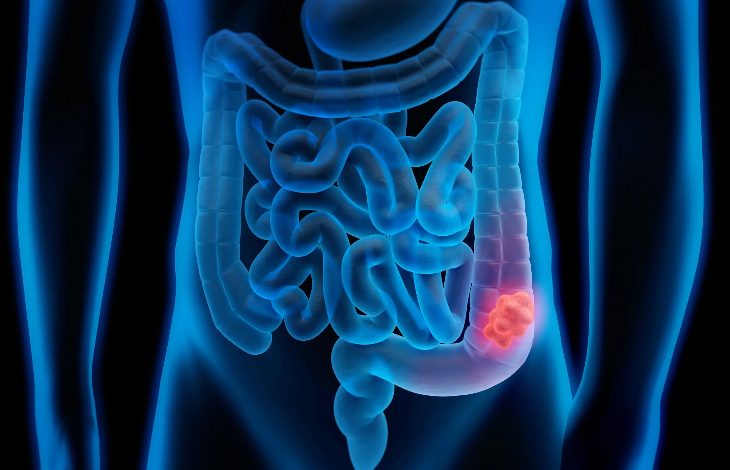 İnsan vücudunun sindirim sistemini gösteren tıbbi bir illüstrasyon yer alıyor. Bağırsaklar mavi tonlarda çizilmiş, kalın bağırsağın bir bölümünde kırmızı renkle vurgulanmış bir alan dikkat çekiyor. Bu bölge olası bir hastalıklı dokuyu ya da tümörü işaret eder şekilde gösterilmiş.