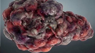 Düz bir arka plan üzerinde, düzensiz şekilli, damarlı ve kabarık yüzeye sahip bir kitle görülüyor. Kırmızı, gri ve mor tonların hâkim olduğu bu yapı, agresif bir tümörü andıran tıbbi bir görselleştirme izlenimi veriyor.