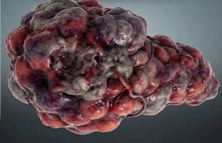 Düz bir arka plan üzerinde, düzensiz şekilli, damarlı ve kabarık yüzeye sahip bir kitle görülüyor. Kırmızı, gri ve mor tonların hâkim olduğu bu yapı, agresif bir tümörü andıran tıbbi bir görselleştirme izlenimi veriyor.