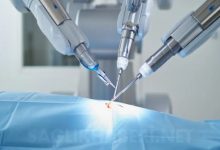 Görselde, modern bir ameliyathane ortamında robotik cerrahi müdahale anı betimleniyor. Üç adet ileri teknoloji ürünü metalik robotik kol, mavi bir örtüyle kaplı hastanın vücudundaki tek bir küçük kesi noktasına (single-port) odaklanmış durumda. Kolların uçlarındaki hassas cerrahi aletler, operasyonun gerçekleştiği noktada birleşiyor. Arka planda ise tıbbi cihazların bulanık, steril ve beyaz ağırlıklı detayları görülüyor.