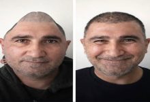 Yan yana iki portre fotoğrafı yer alıyor. Aynı erkeğin ameliyat öncesi ve sonrası hâli gösterilmiş. Solda başının üst kısmında ciddi bir şekil bozukluğu dikkat çekerken, sağdaki görüntüde kafatası daha düzgün görünüyor ve kişi hafifçe gülümsüyor. Yüz ifadesi daha rahat ve toparlanmış bir izlenim veriyor.