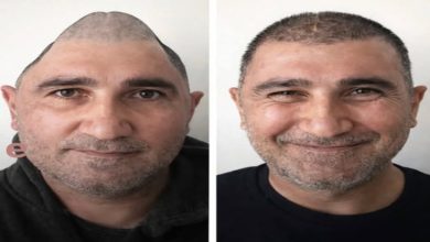 Yan yana iki portre fotoğrafı yer alıyor. Aynı erkeğin ameliyat öncesi ve sonrası hâli gösterilmiş. Solda başının üst kısmında ciddi bir şekil bozukluğu dikkat çekerken, sağdaki görüntüde kafatası daha düzgün görünüyor ve kişi hafifçe gülümsüyor. Yüz ifadesi daha rahat ve toparlanmış bir izlenim veriyor.