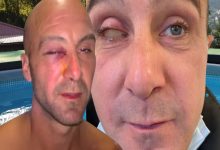 Yan yana yerleştirilmiş iki yakın plan yüz görüntüsünde, iki kişinin göz çevresinde ciddi hasar dikkat çekiyor. Soldaki kişinin gözü morarmış ve akıntı var; sağdaki kişinin ise bir gözü ciddi şekilde şişmiş ve kapalı. Görseller, ağır bir göz yaralanmasını vurgulayan çarpıcı bir durum sunuyor.